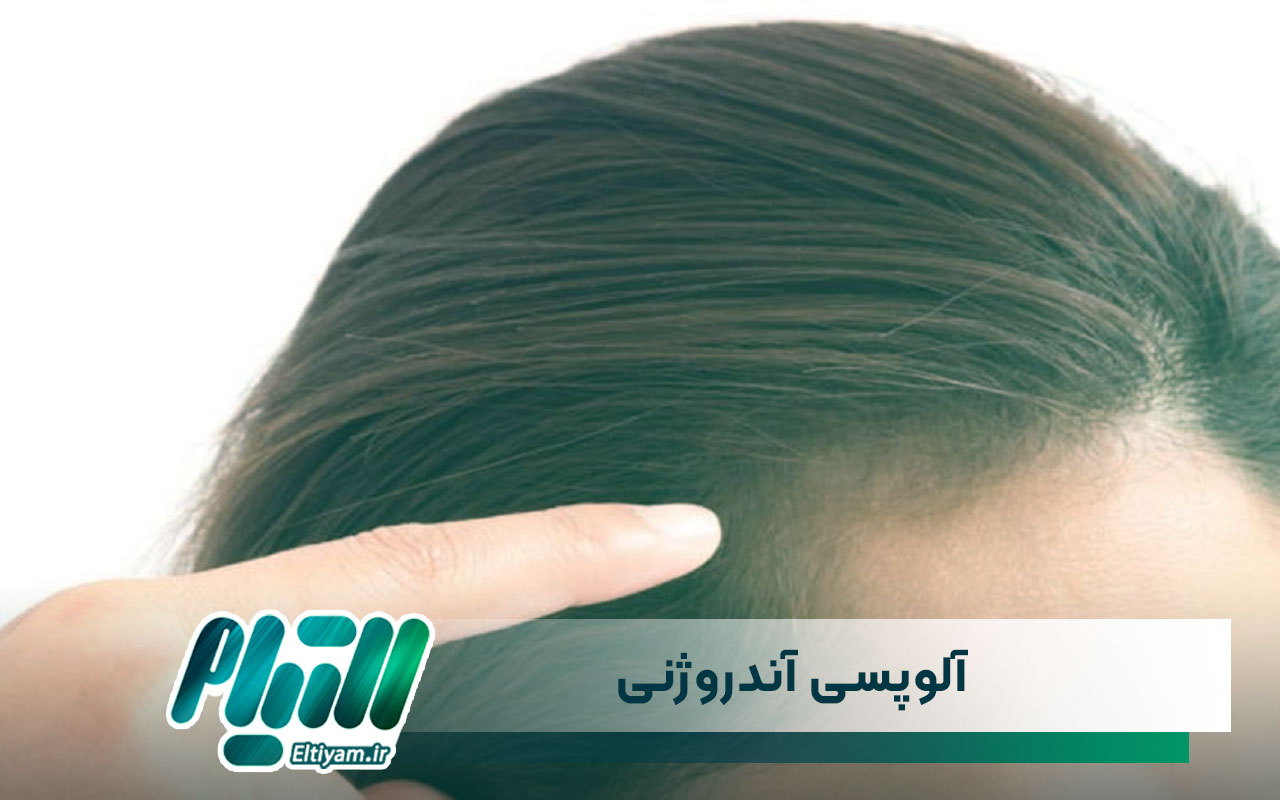 آلوپسی آندروژنی چگونه به وجود می آید؟