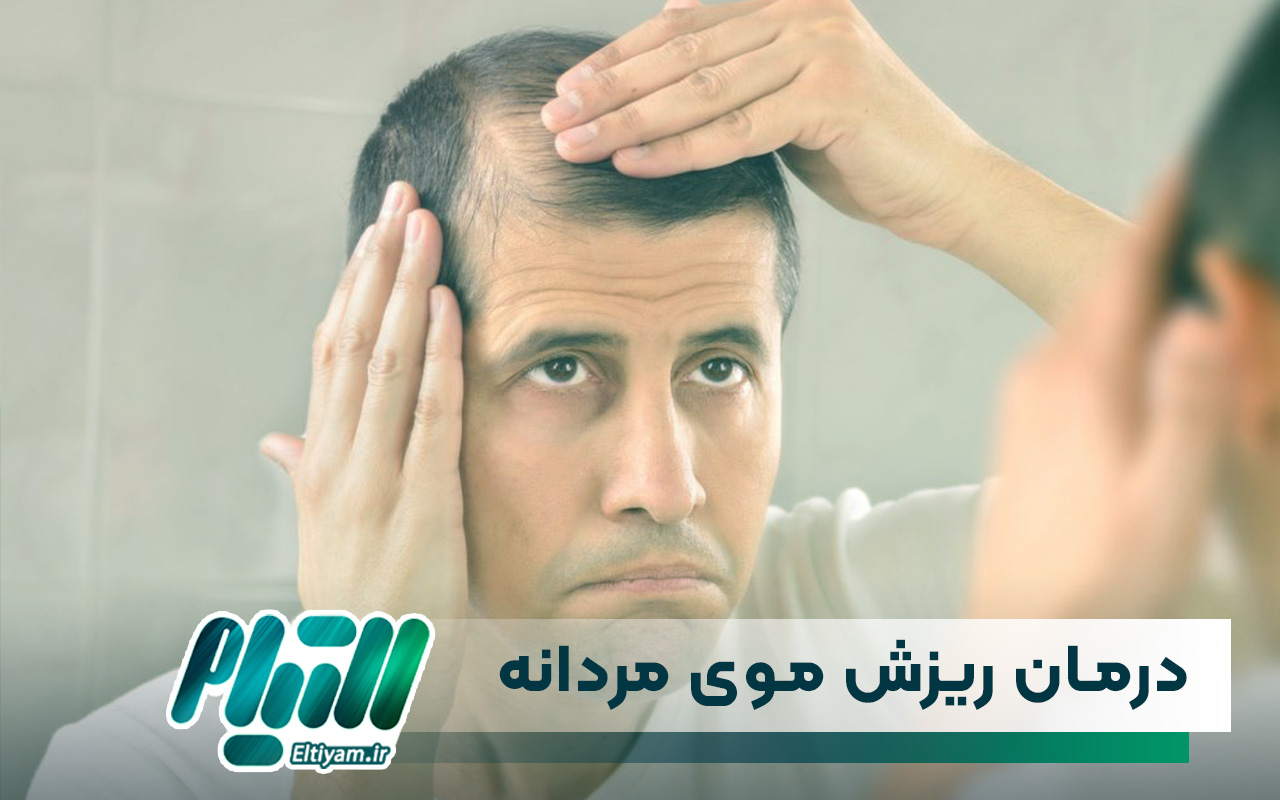 روش های درمان ریزش موی مردانه