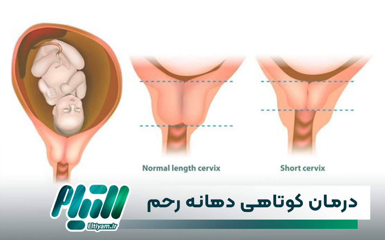 درمان کوتاهی دهانه رحم