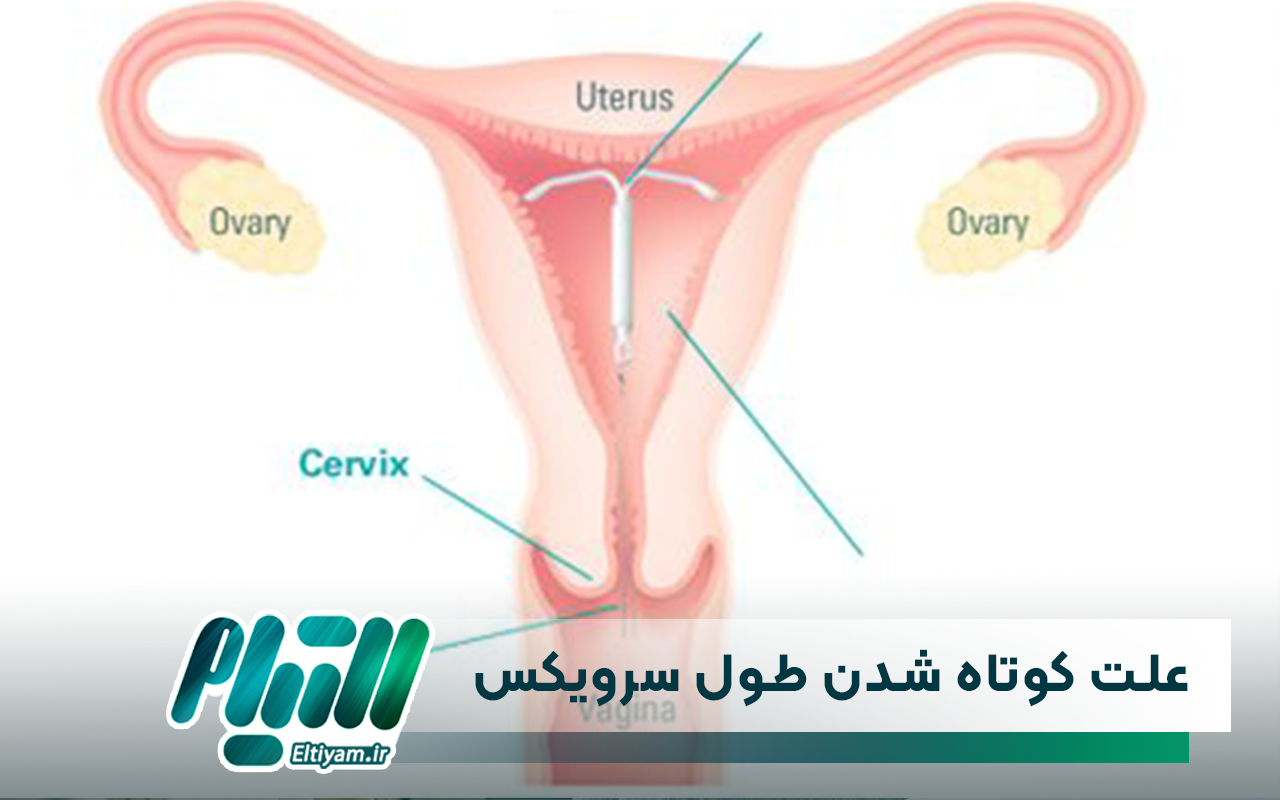 علت کوتاه شدن طول سرویکس