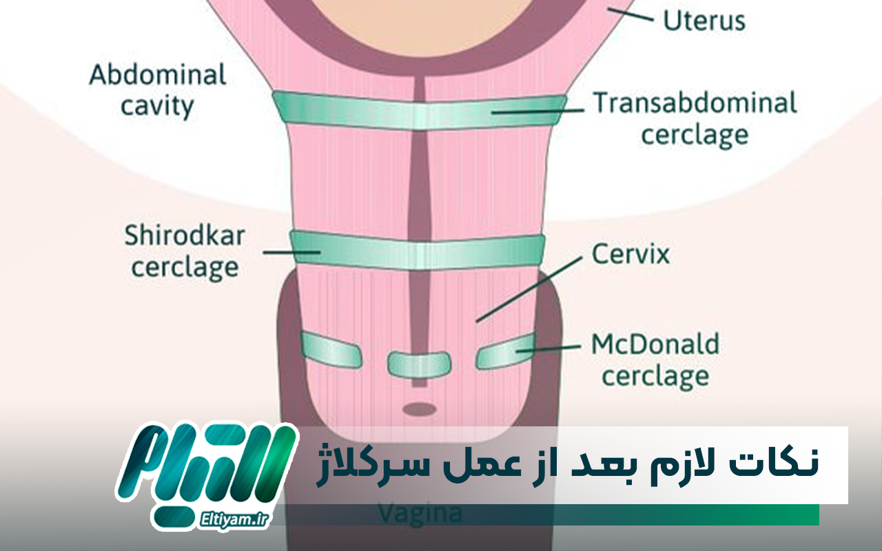 نکات لازم بعد از عمل سرکلاژ