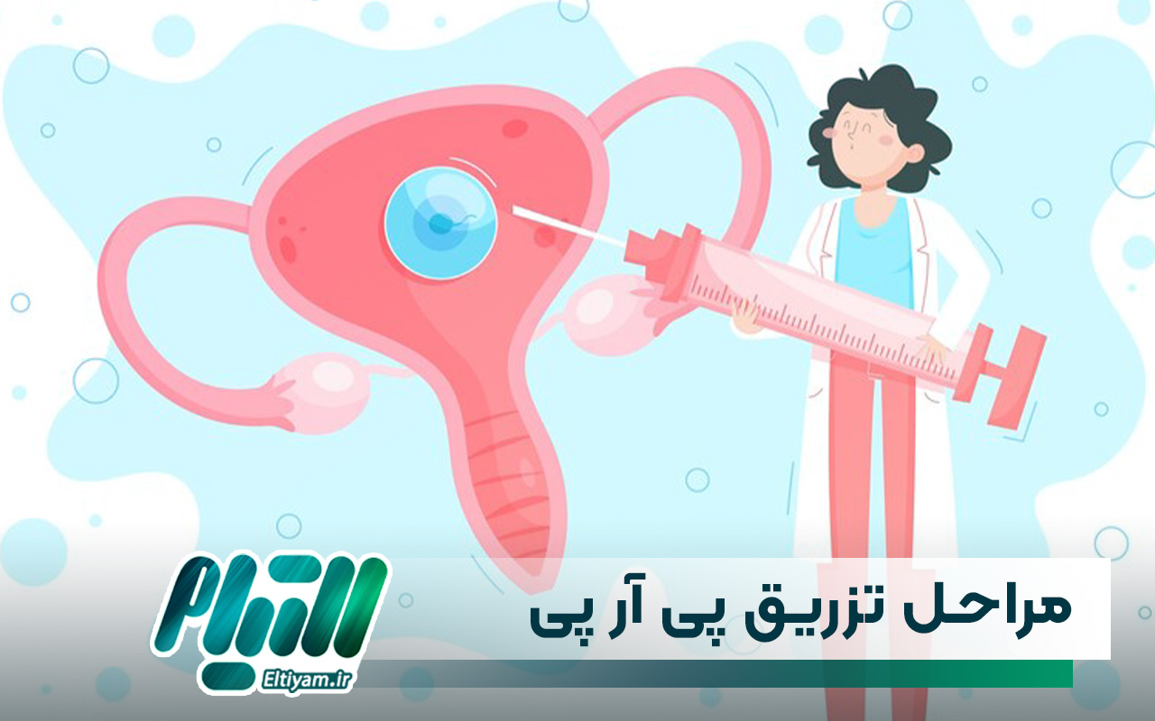 مراحل تزریق پی آر پی