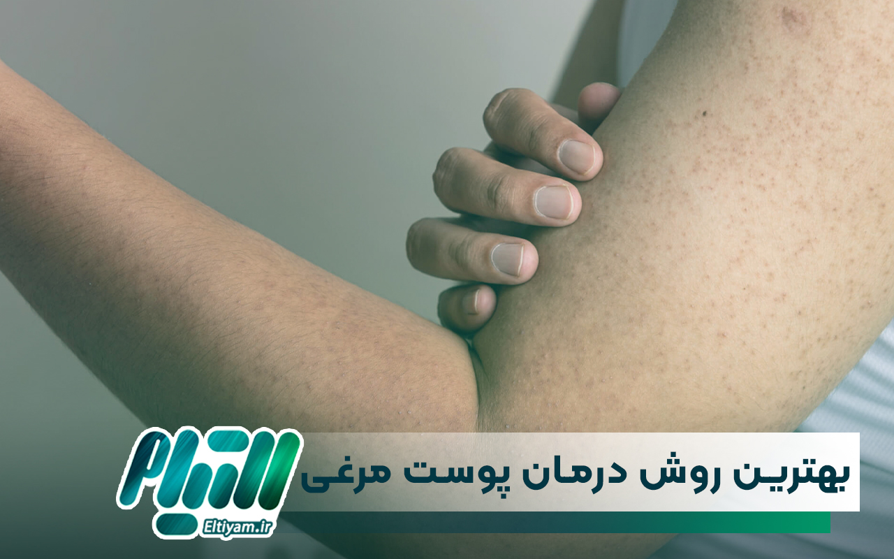 بهترین روش درمان پوست مرغی