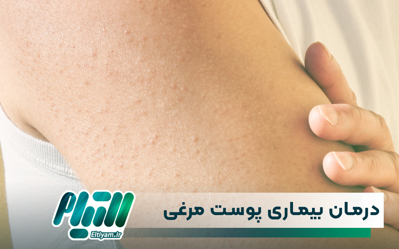 درمان بیماری پوست مرغی