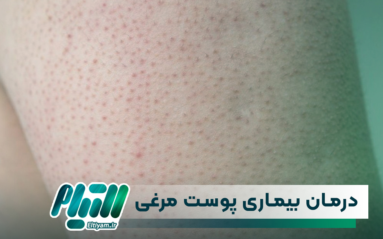 درمان بیماری پوست مرغی