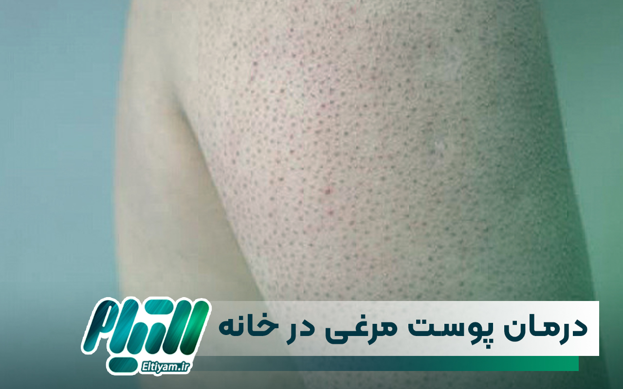 درمان پوست مرغی در خانه