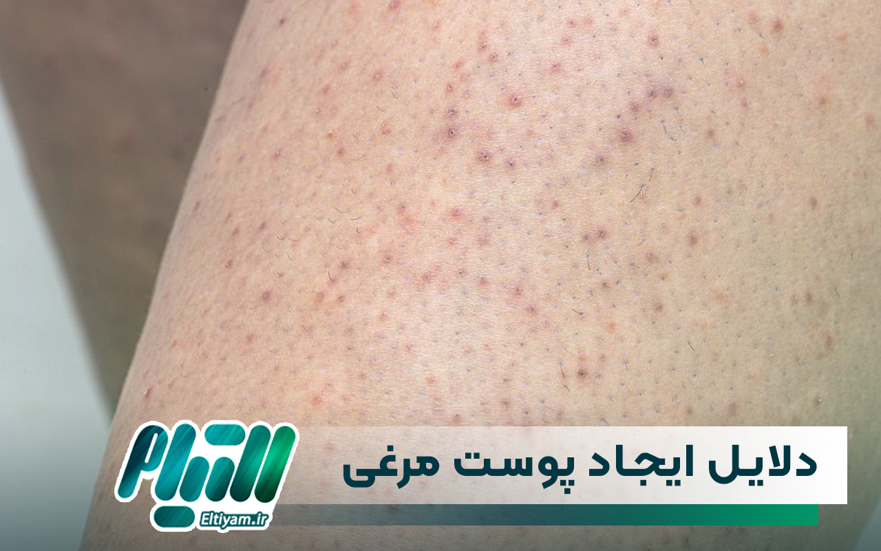 دلایل ایجاد پوست مرغی