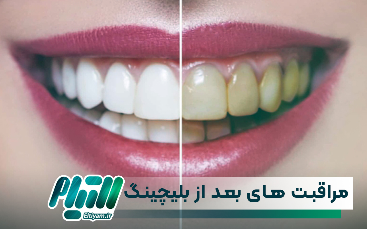 مراقبت های بعد از بلیچینگ دندان
