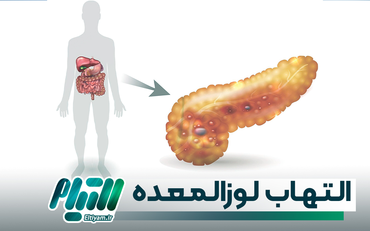 التهاب لوزالمعده