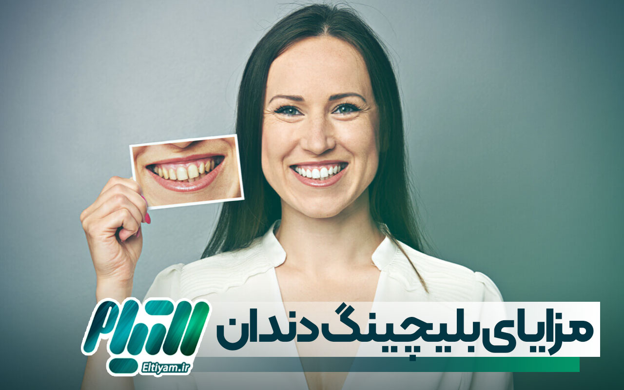 مزایای بلیچینگ دندان