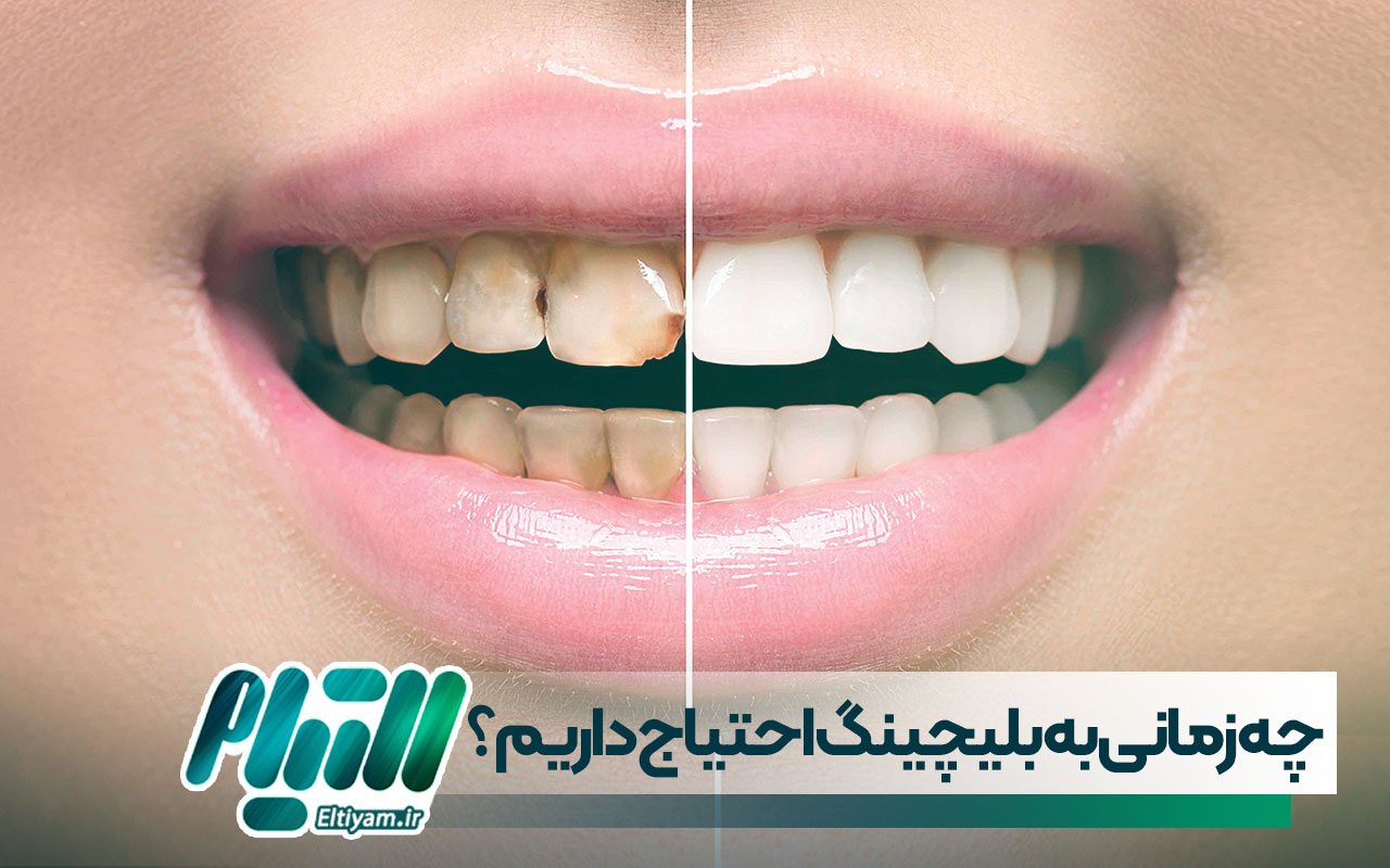 چه زمانی به بلیچینگ احتیاج داریم؟