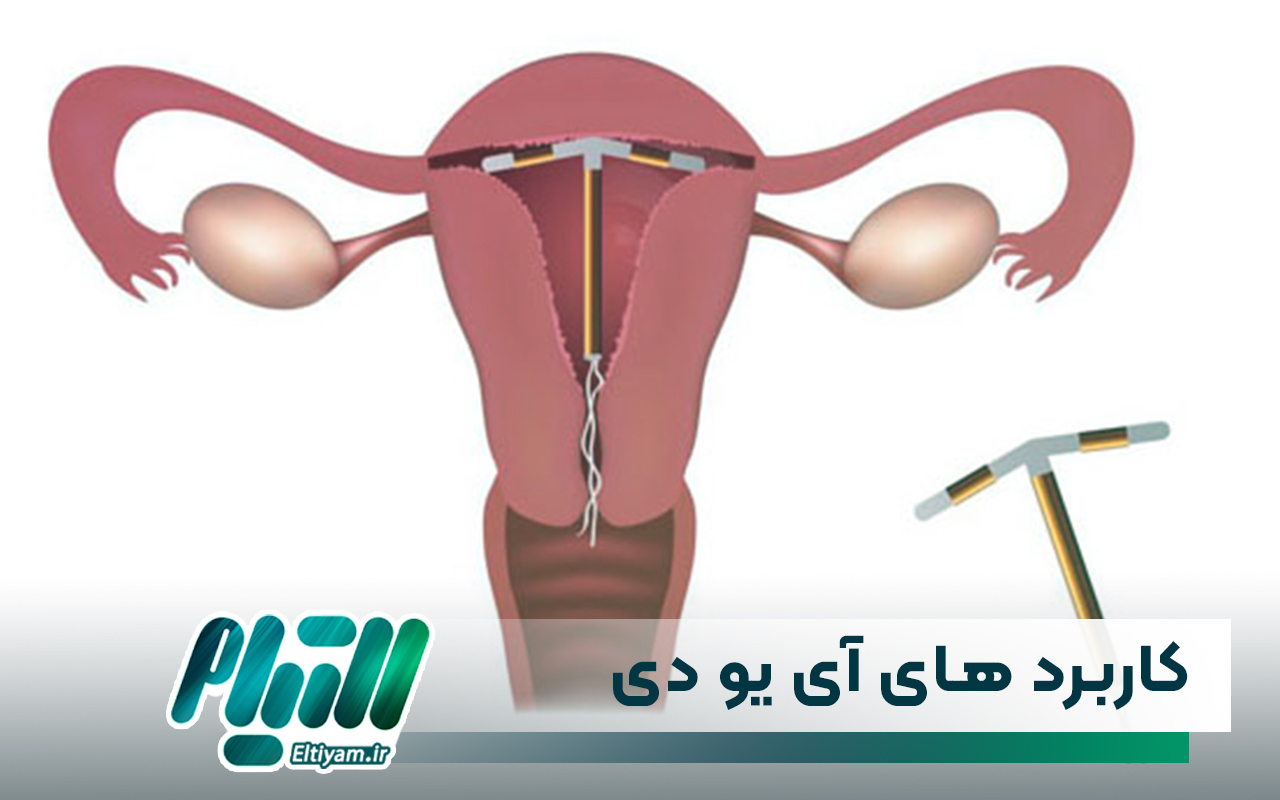 کاربرد های آی یو دی