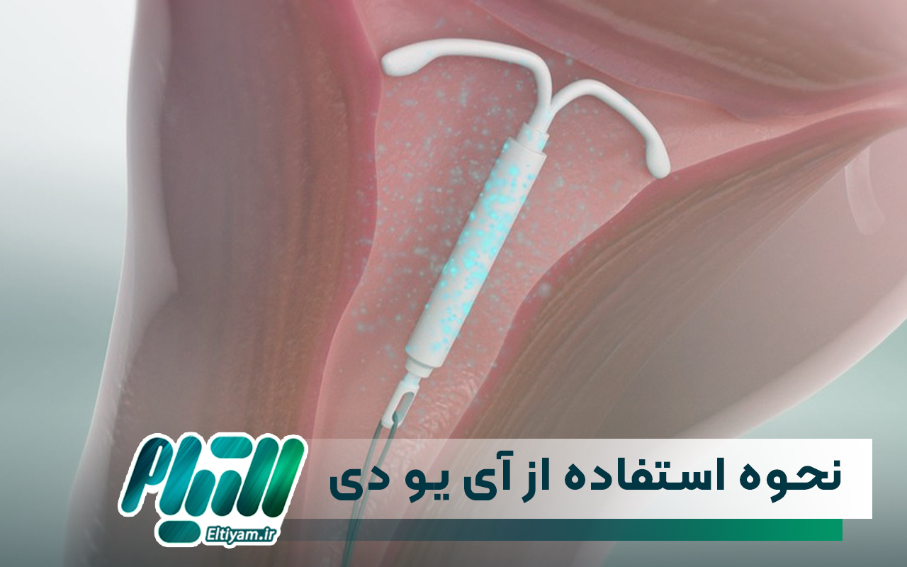 نحوه استفاده از آی یو دی