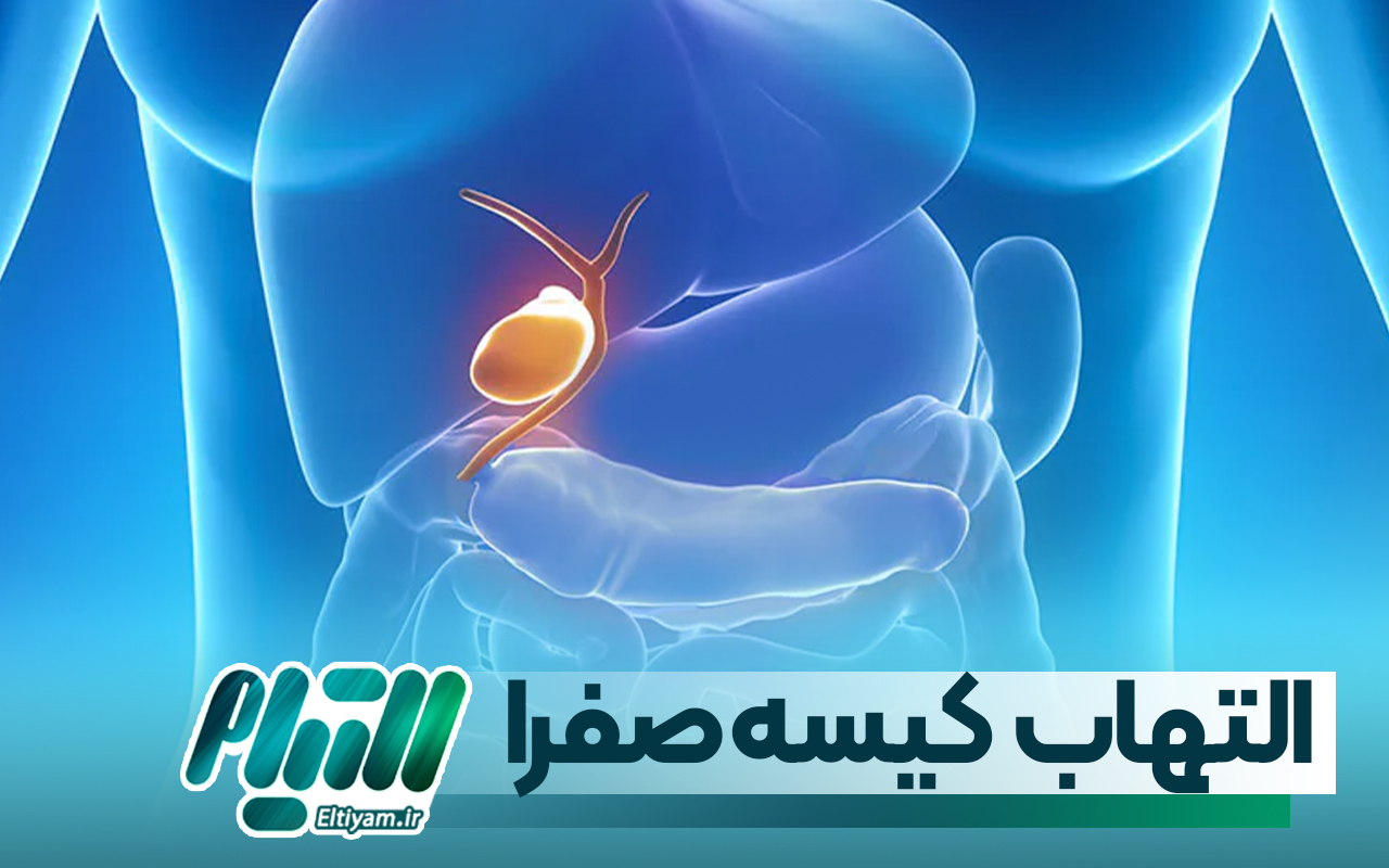 التهاب کیسه صفرا