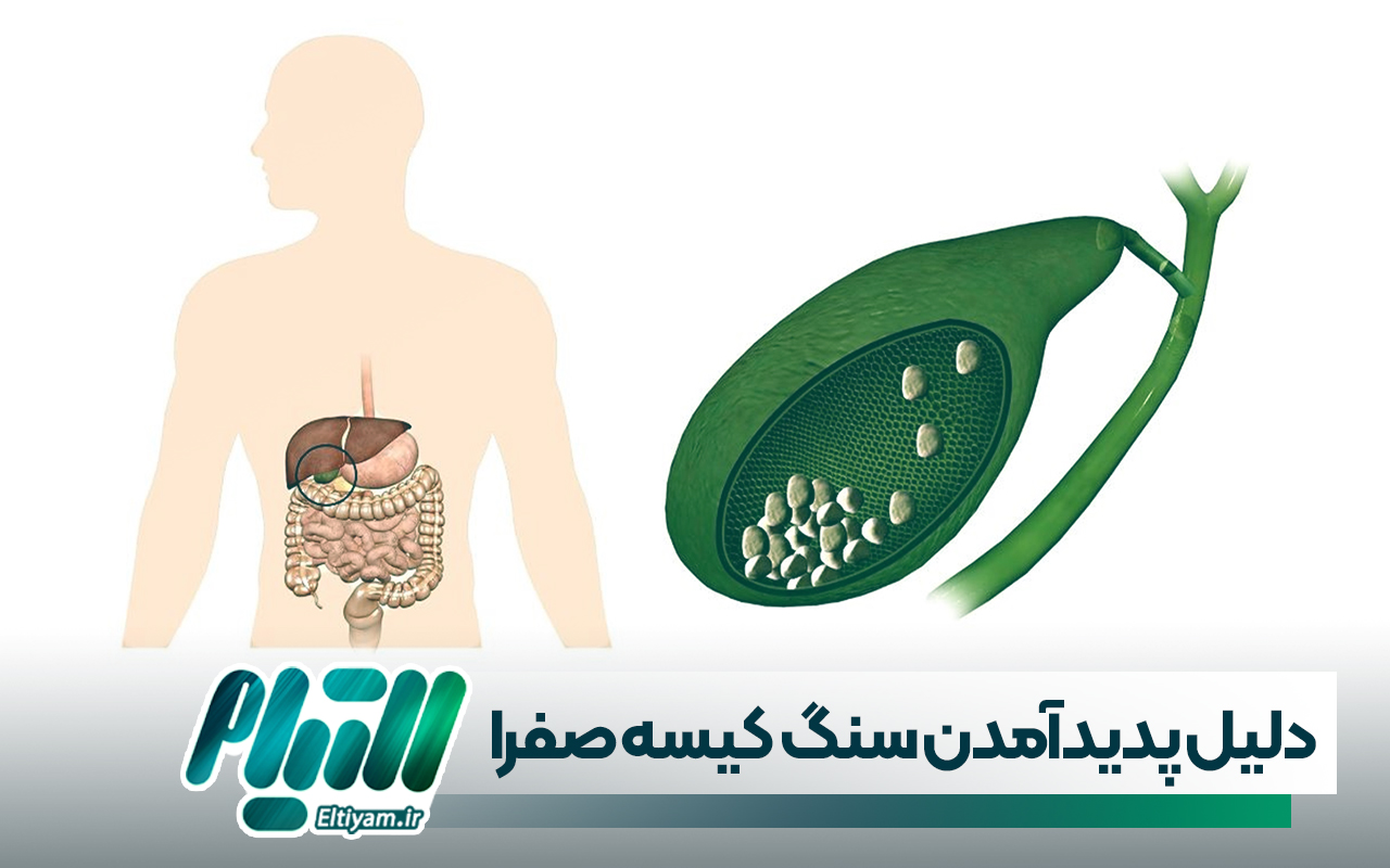 دلایل پدید آمدن سنگ کیسه صفرا