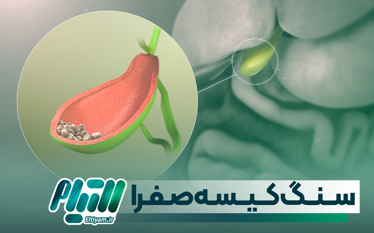 سنگ کیسه صفرا