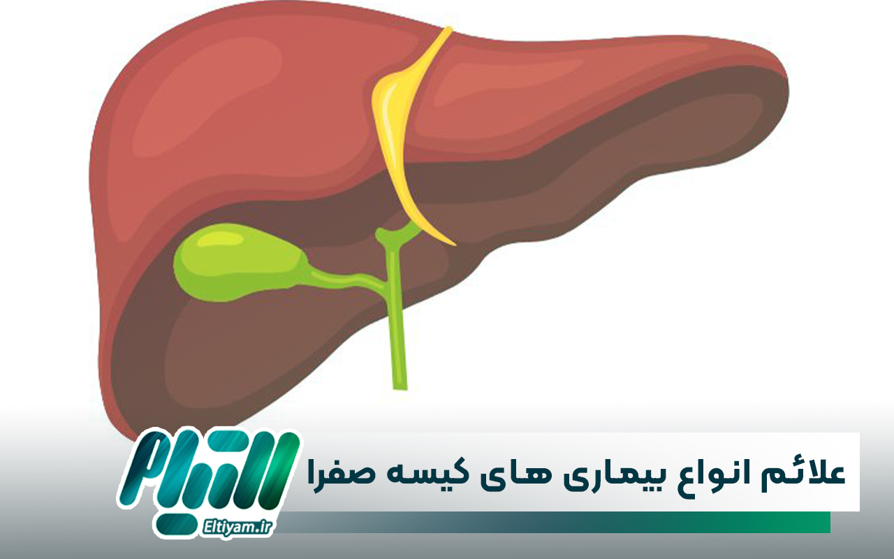 علائم انواع بیماری های کیسه صفرا