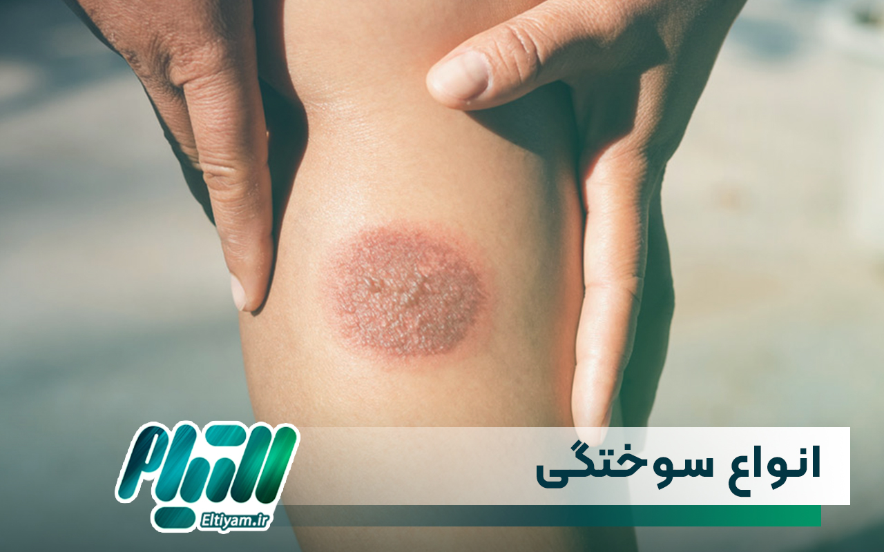انواع سوختگی