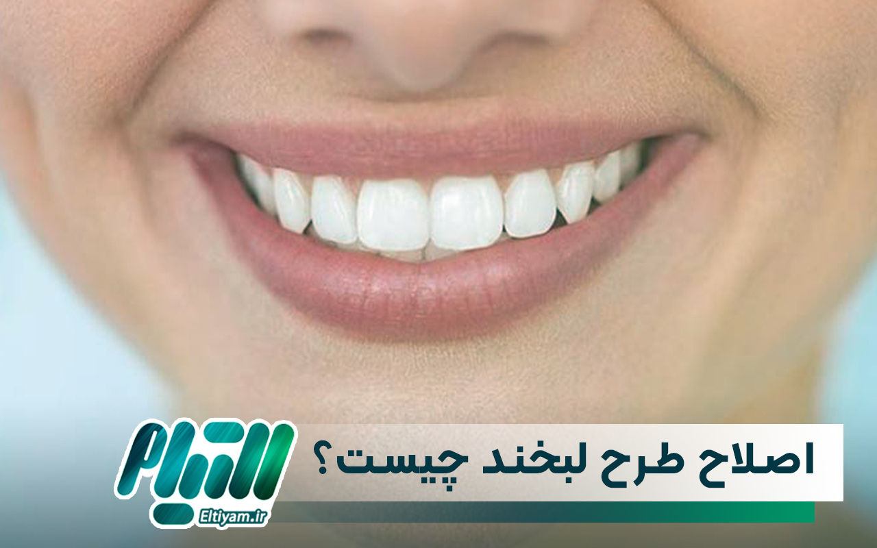 اصلاح طرح لبخند چیست؟