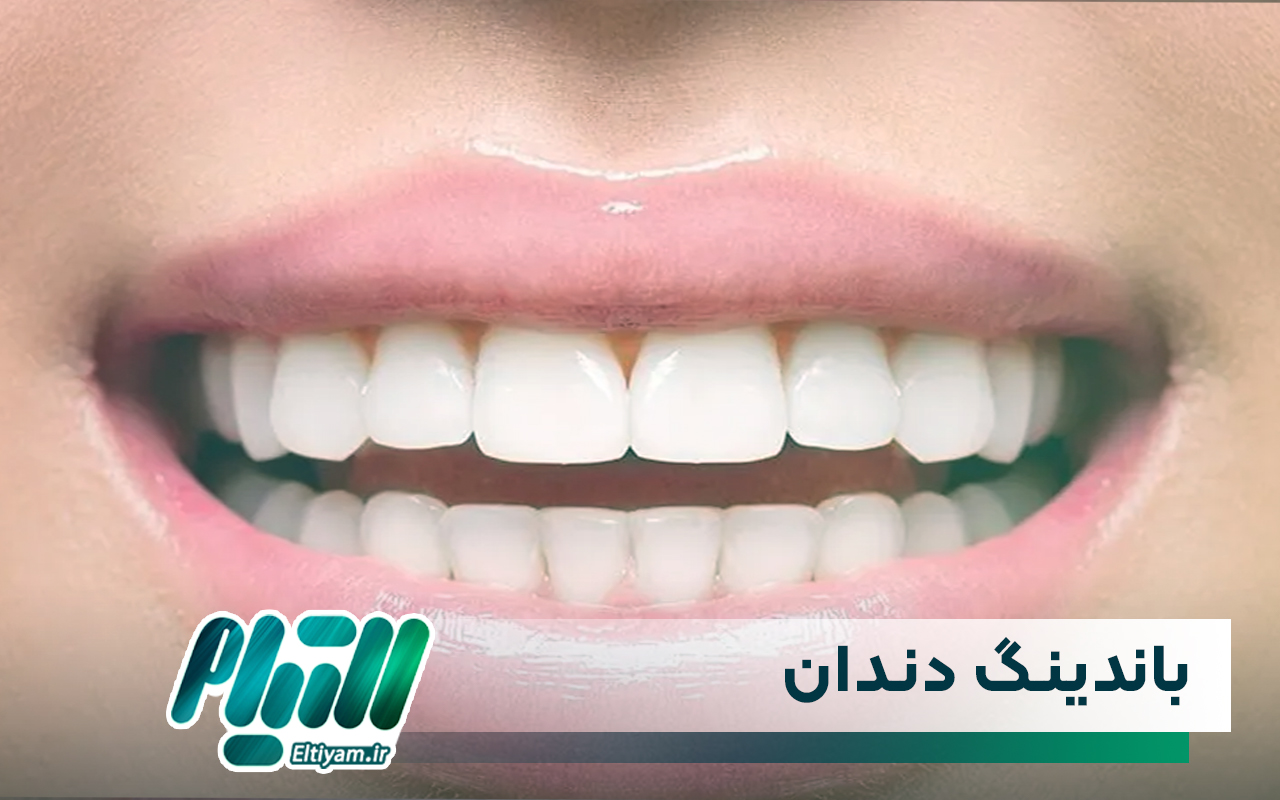 باندینگ دندان