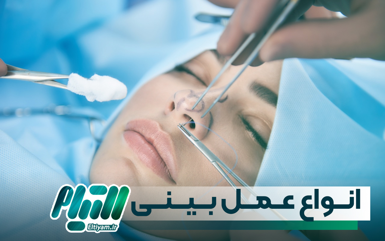 توضیحی مختصر درباره انواع عمل بینی
