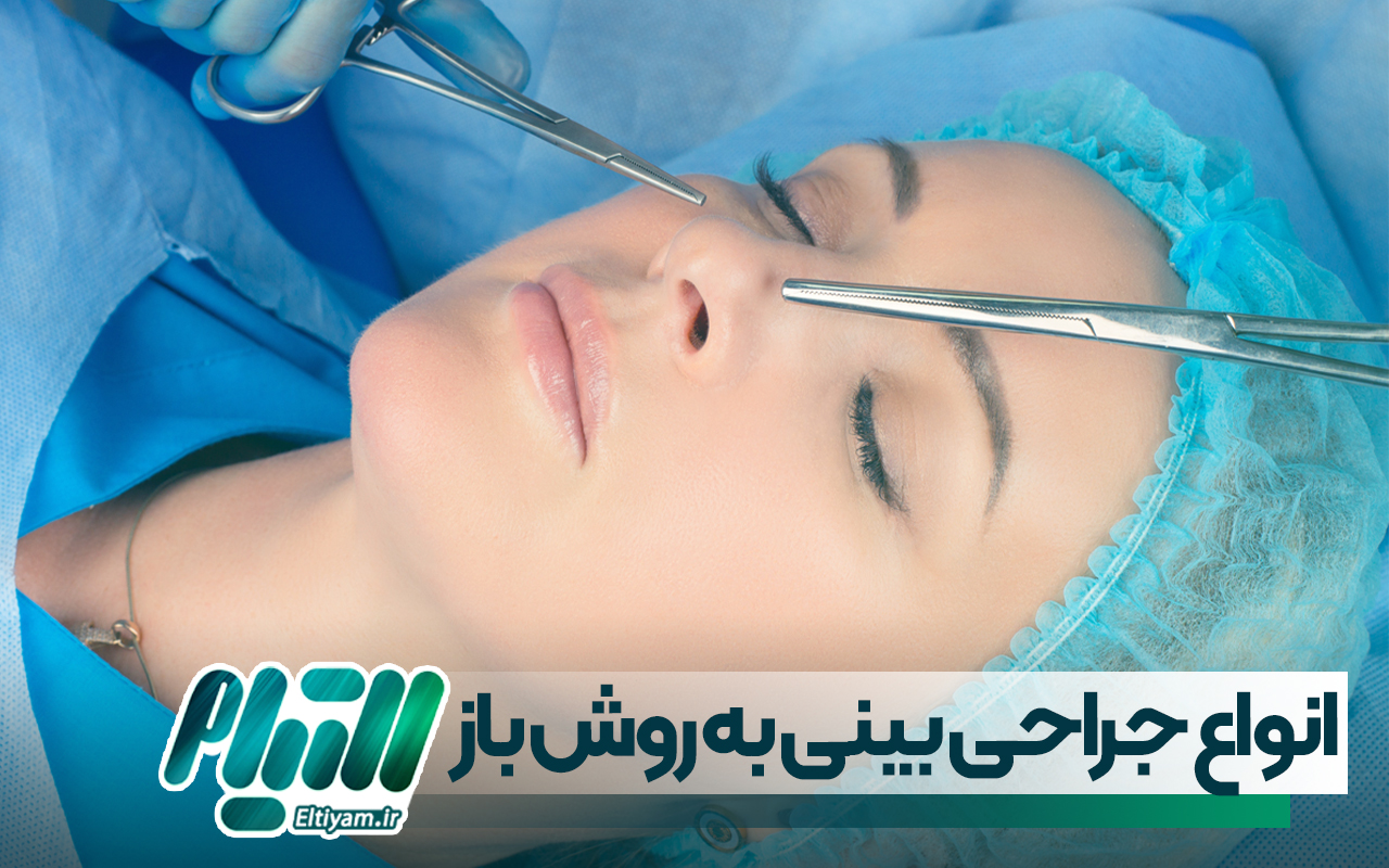انواع جراحی بینی به روش باز