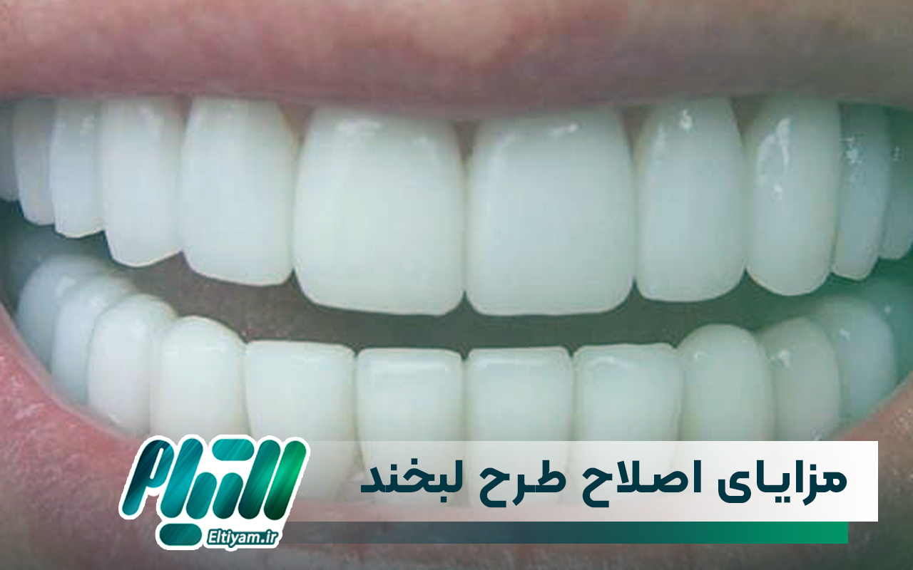 مزایای اصلاح طرح لبخند