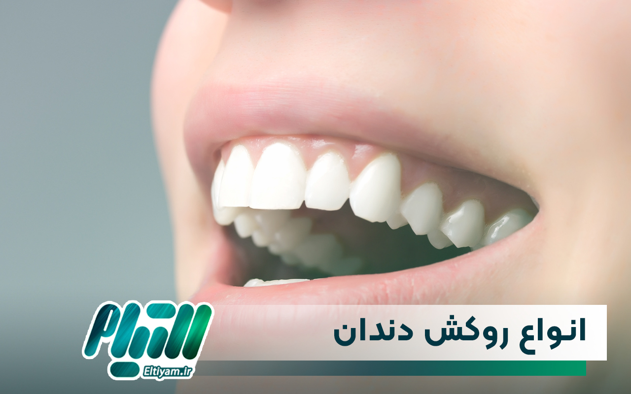 انواع مختلف روکش دندان