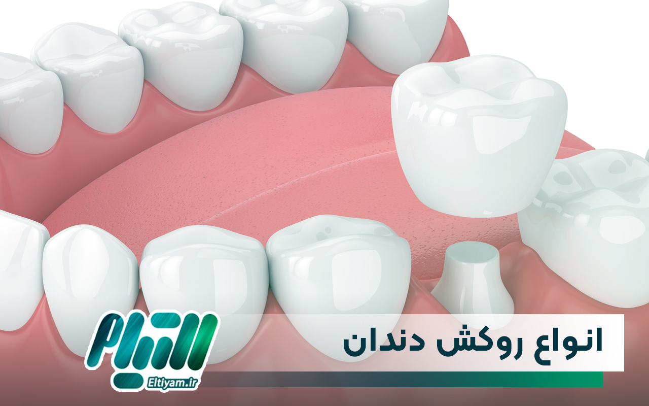انواع روکش دندان
