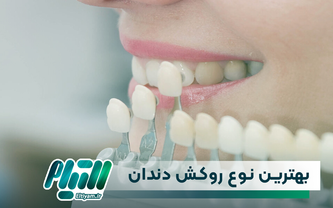 بهترین نوع روکش دندان