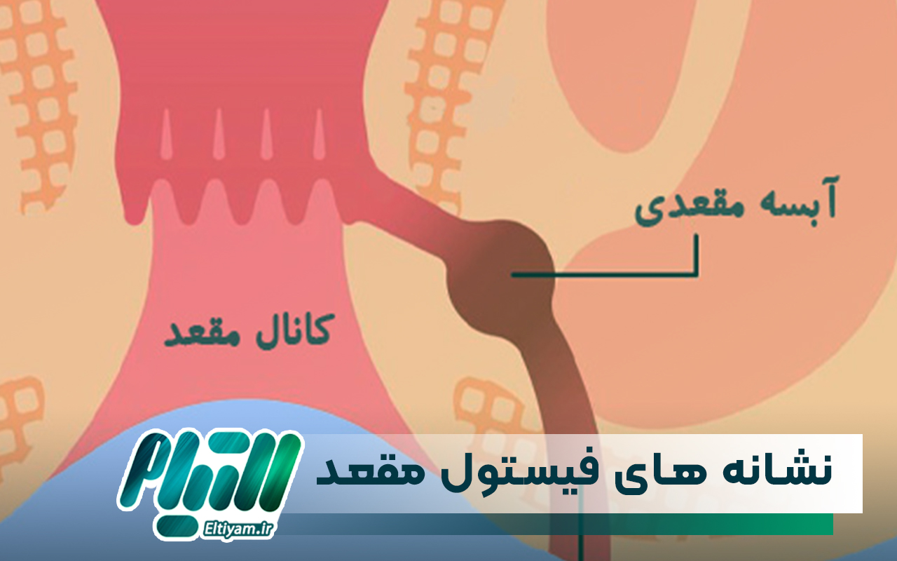 نشانه های فیستول مقعدی چیست؟